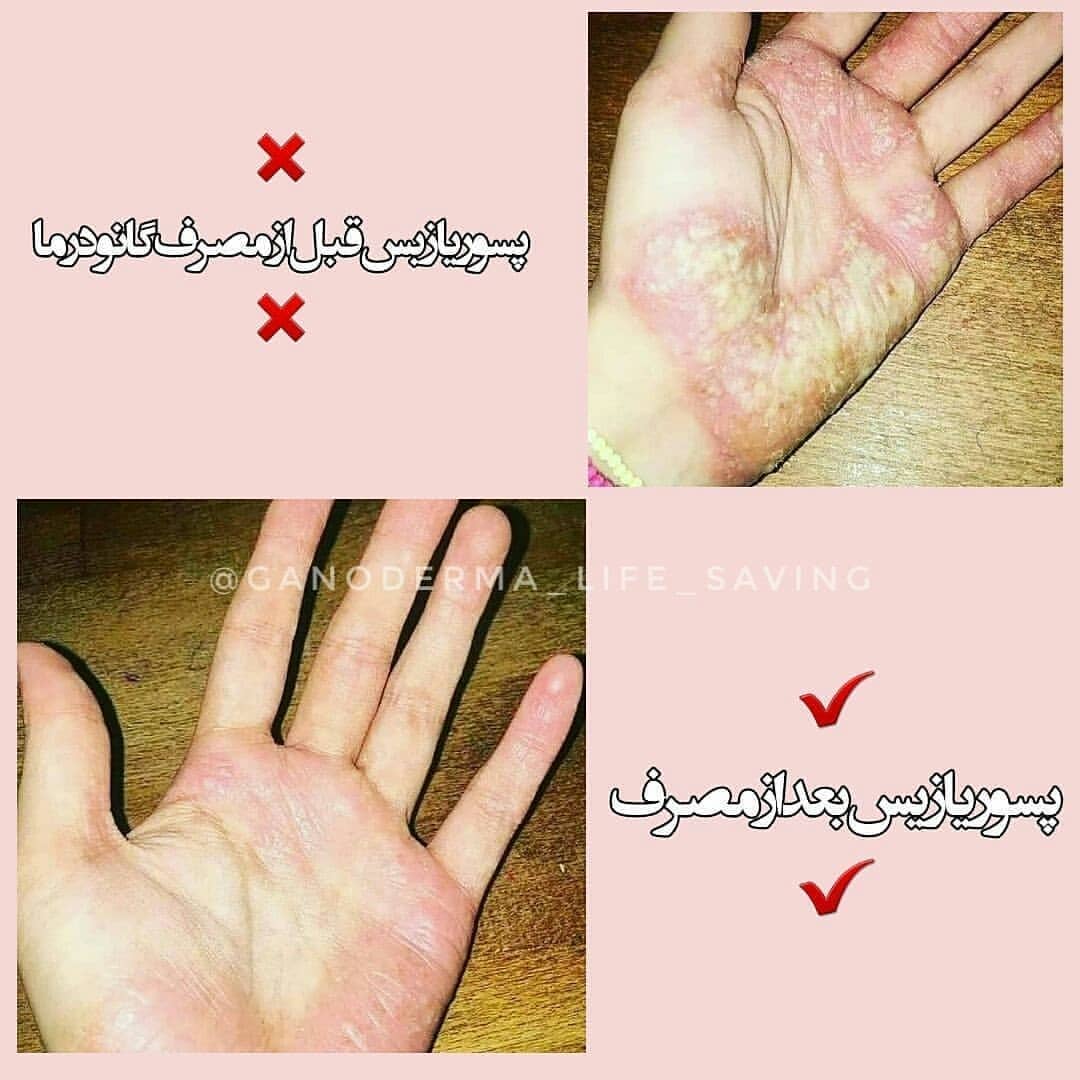 قارچ معجزه گر گانودرما