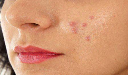 مواد غذایی محرک آکنه