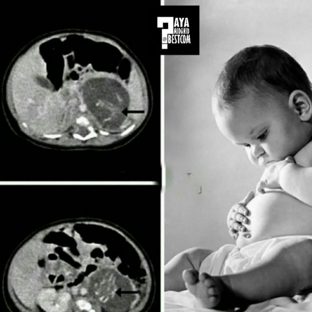 نوزاد دخترى در هنگ کنگ باردار به دنیا آمد