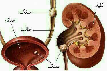 کلیه شن ساز