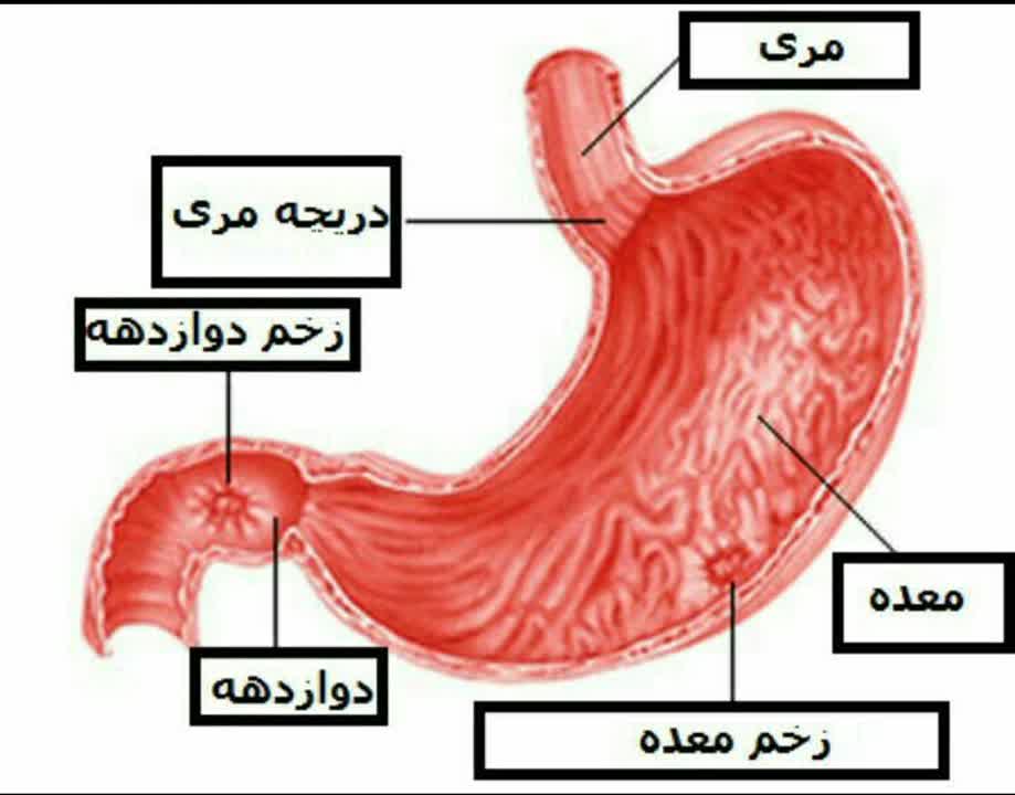 نشانه های زخم معده