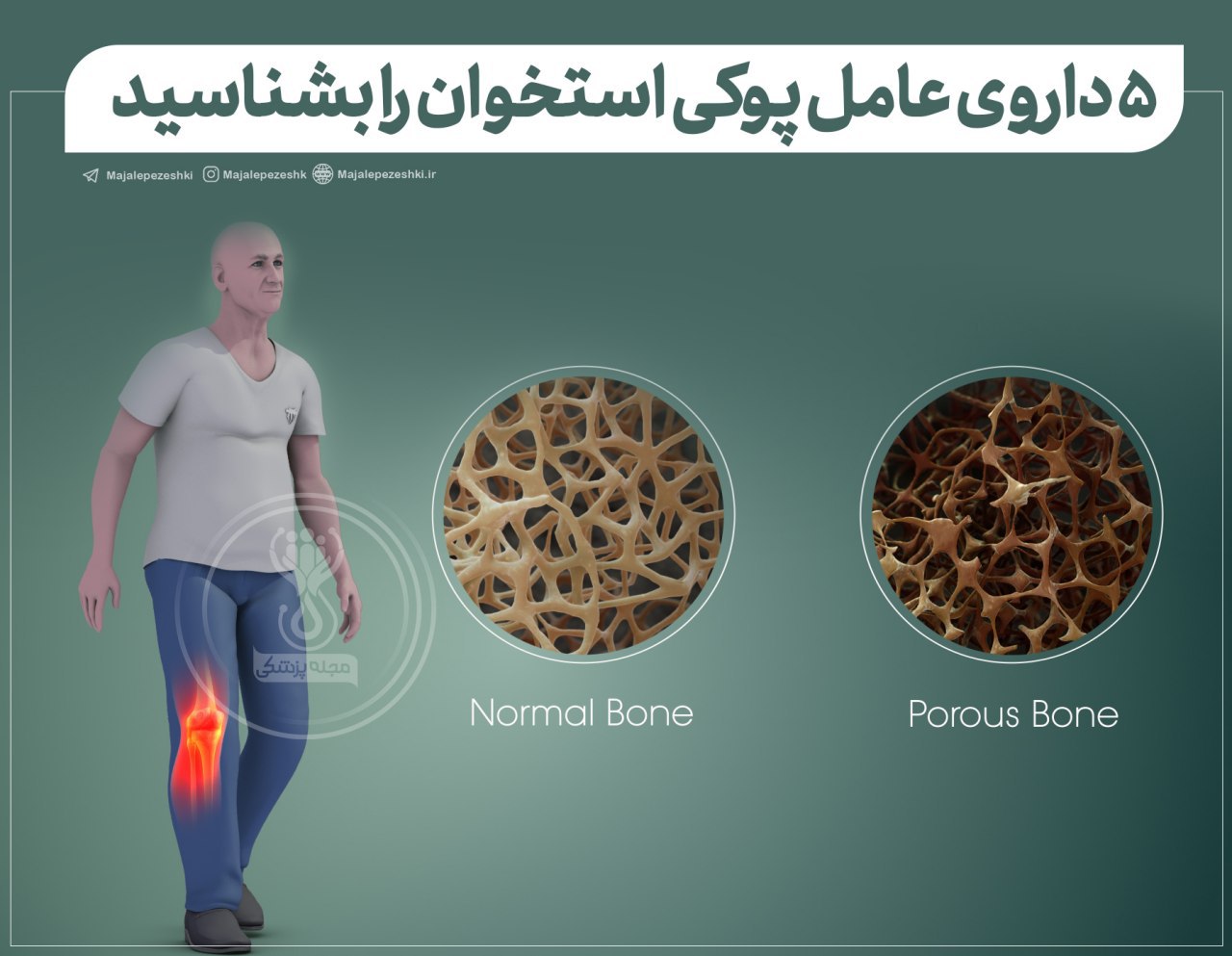 دارو هایی که پوکی استخوان را به همراه دارند