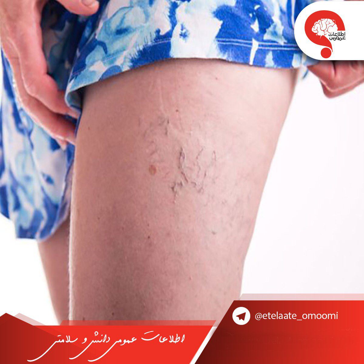 واریس چیست