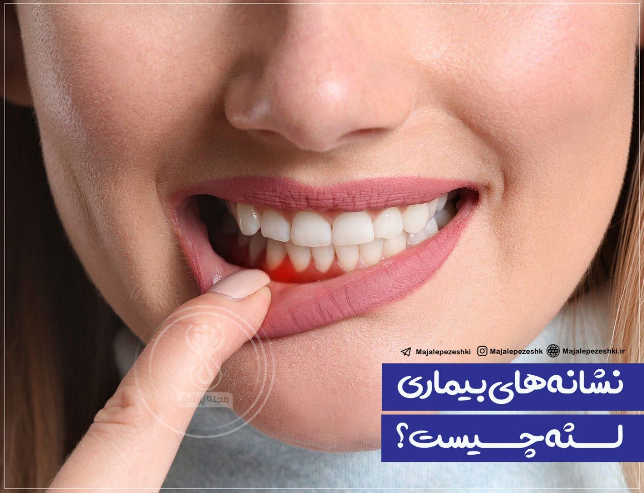 بیماریهای لثه