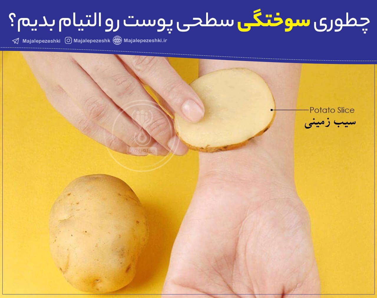 التیام سوختگی سطحی