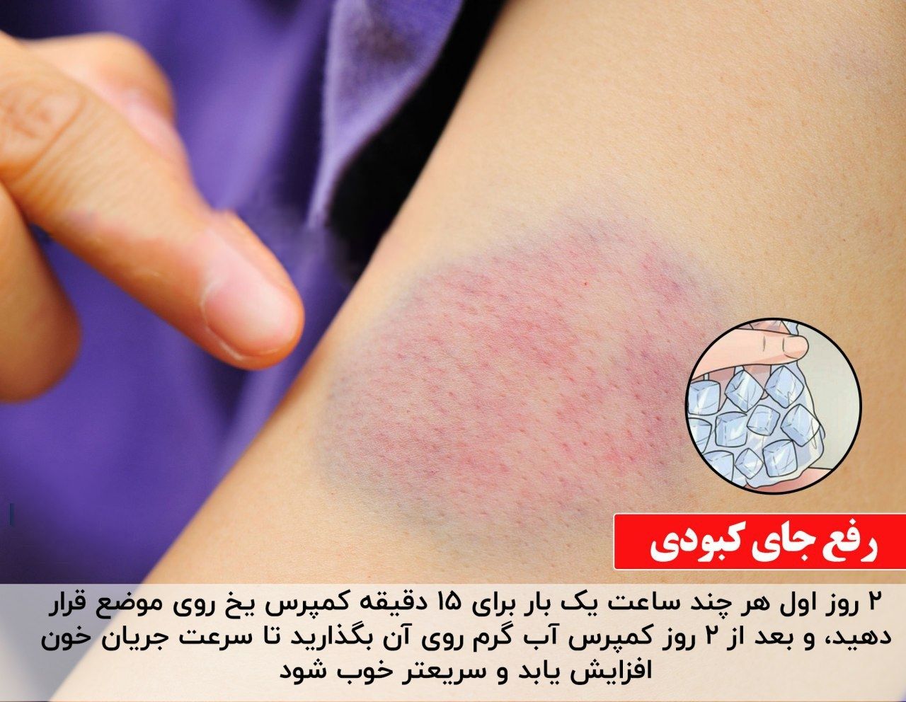 رفع جای کبودی