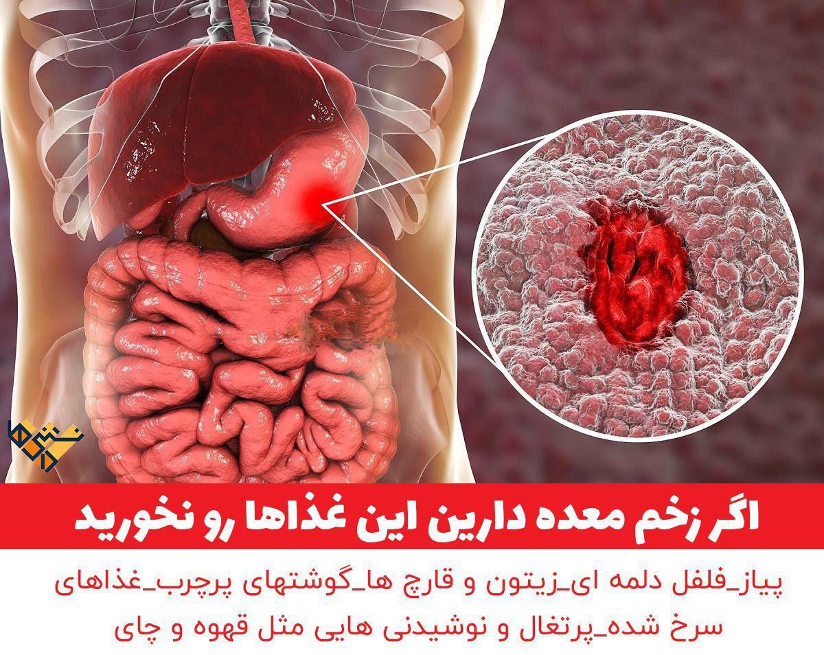 غذاهای مضر برای معده