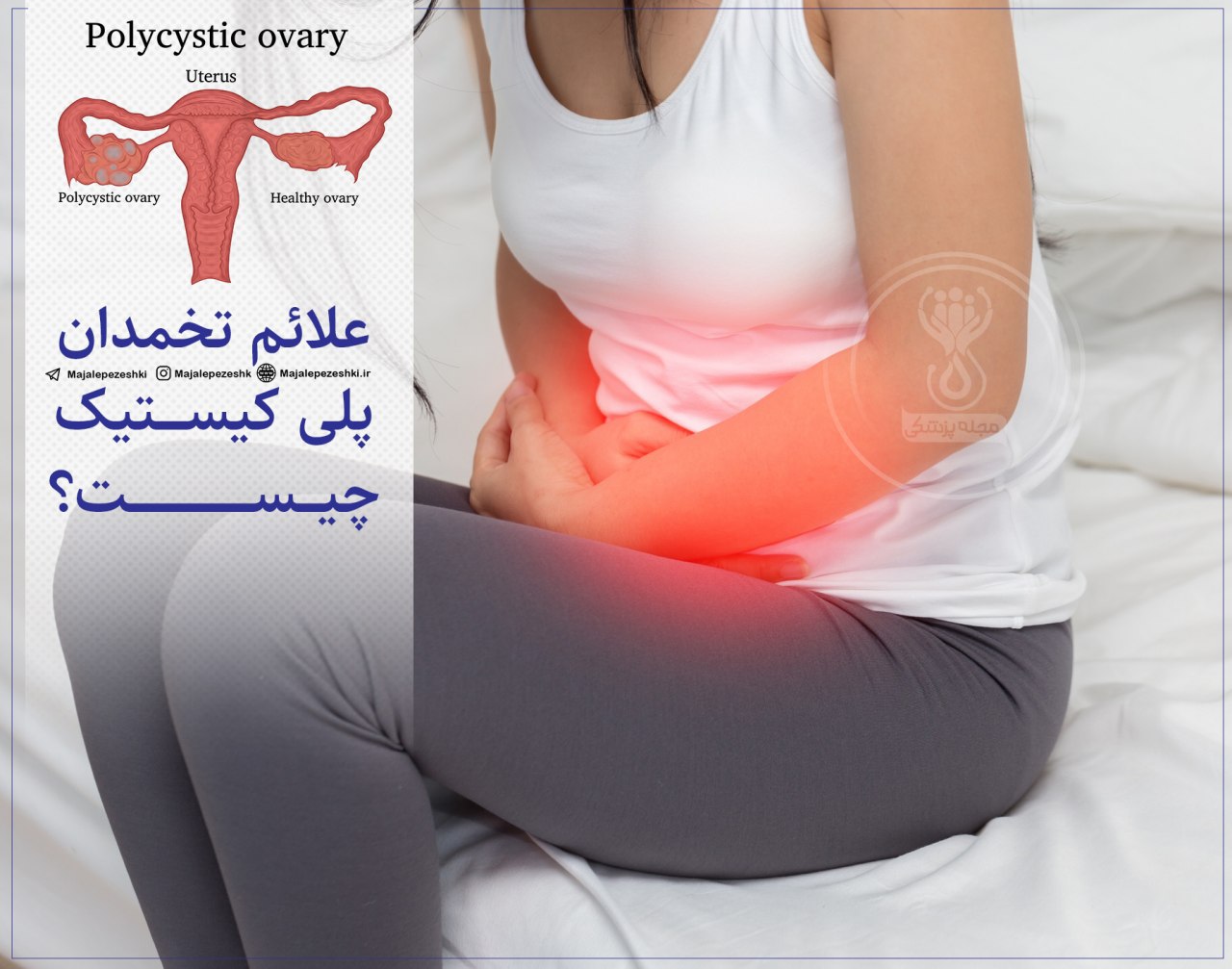 تخمدان پلی کیستیک