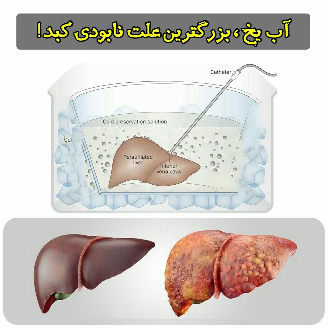 بزرگترین علت نابودی کبد