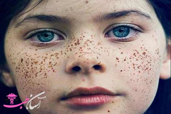 چگونه از ایجاد کک و مک، جلوگیری کنیم؟