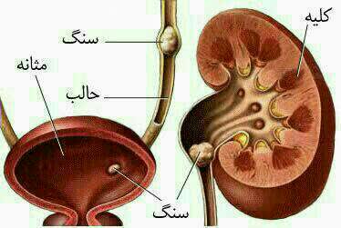 اگر کلیه شن سازی دارید 