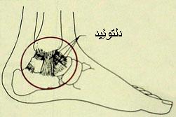 پیچ خوردگی داخلی مچ پا