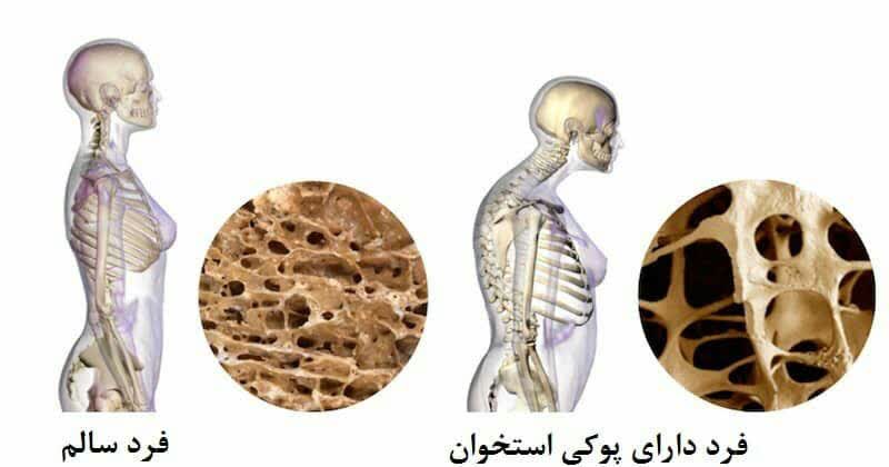 معجون برای پوکی استخوان