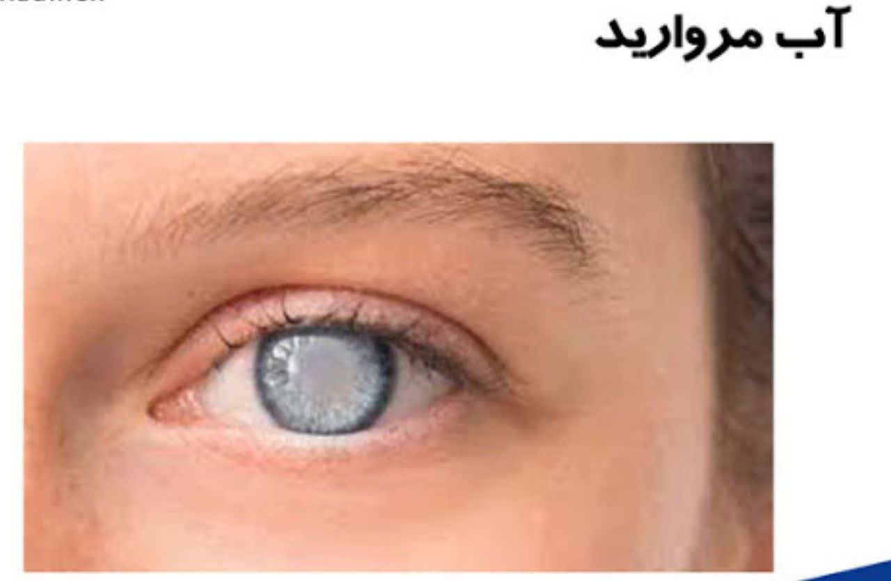 آب مروارید