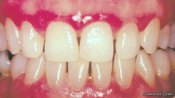  علت تورم لثه چیست؟