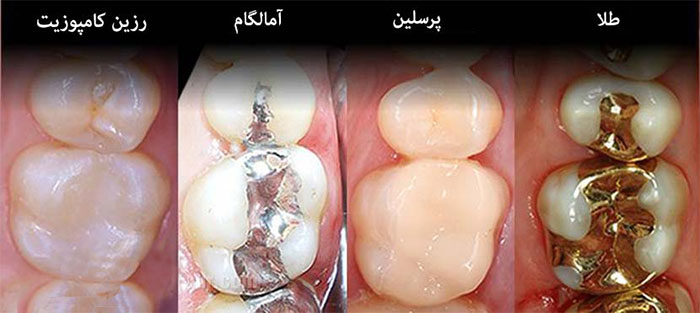 مراحل پرکردن دندان
