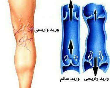 ارزان ترین روش درمان واریس