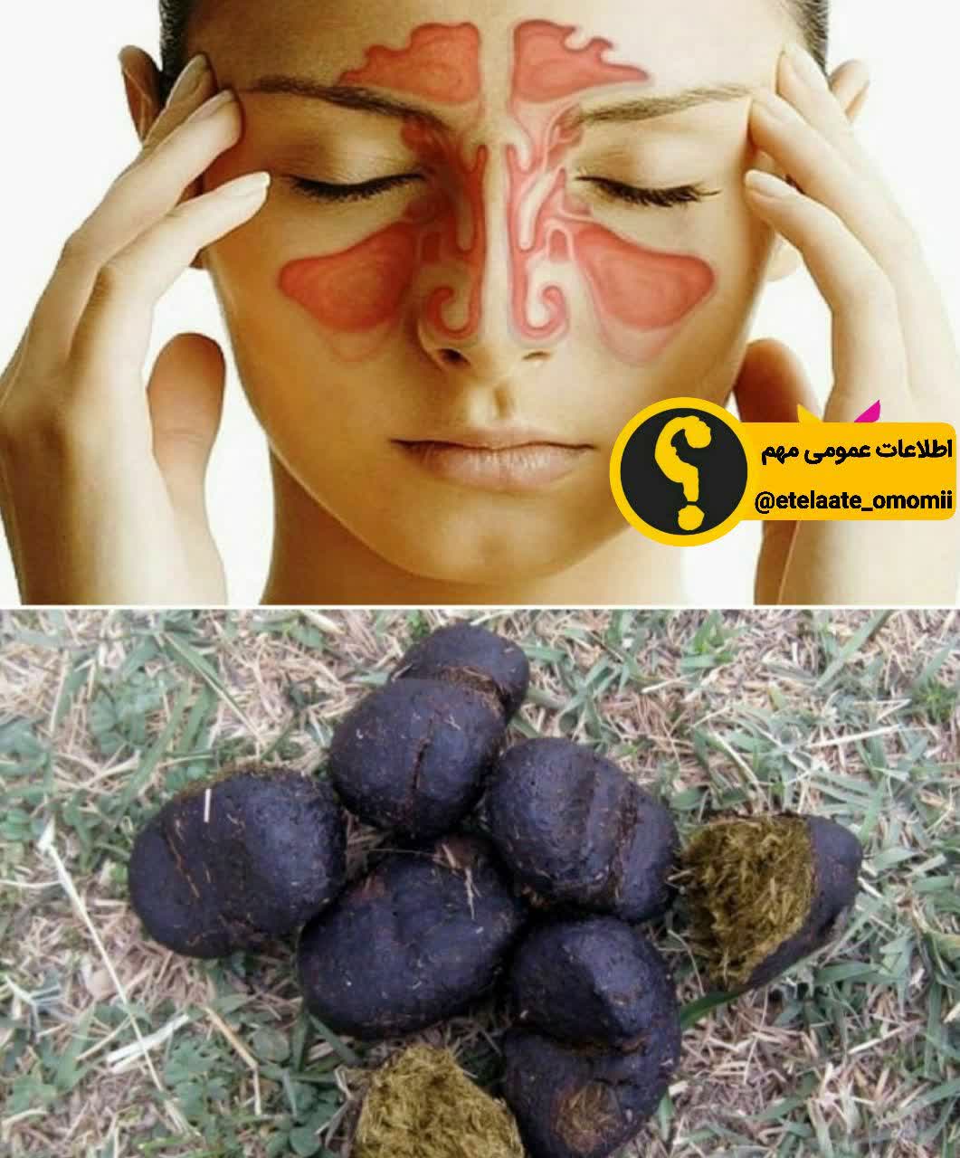 سینوزیت
