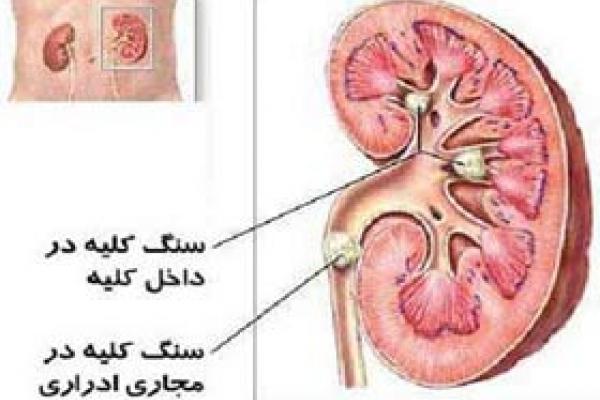 سنگ کلیه ، پیشگیری و درمان در طب سنتی