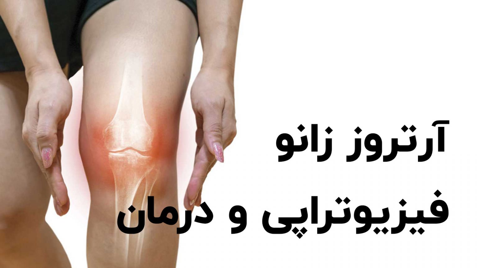 پیشگیری و درمان آرتروز مفصل زانو