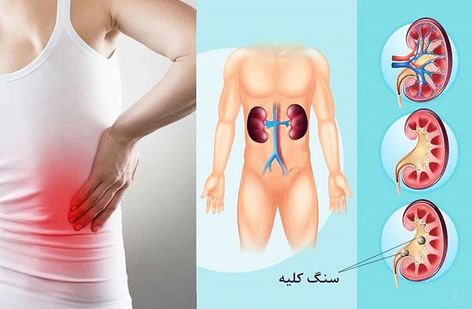 درمان سنگ کلیه طب سنتی گیاهی اسلامی