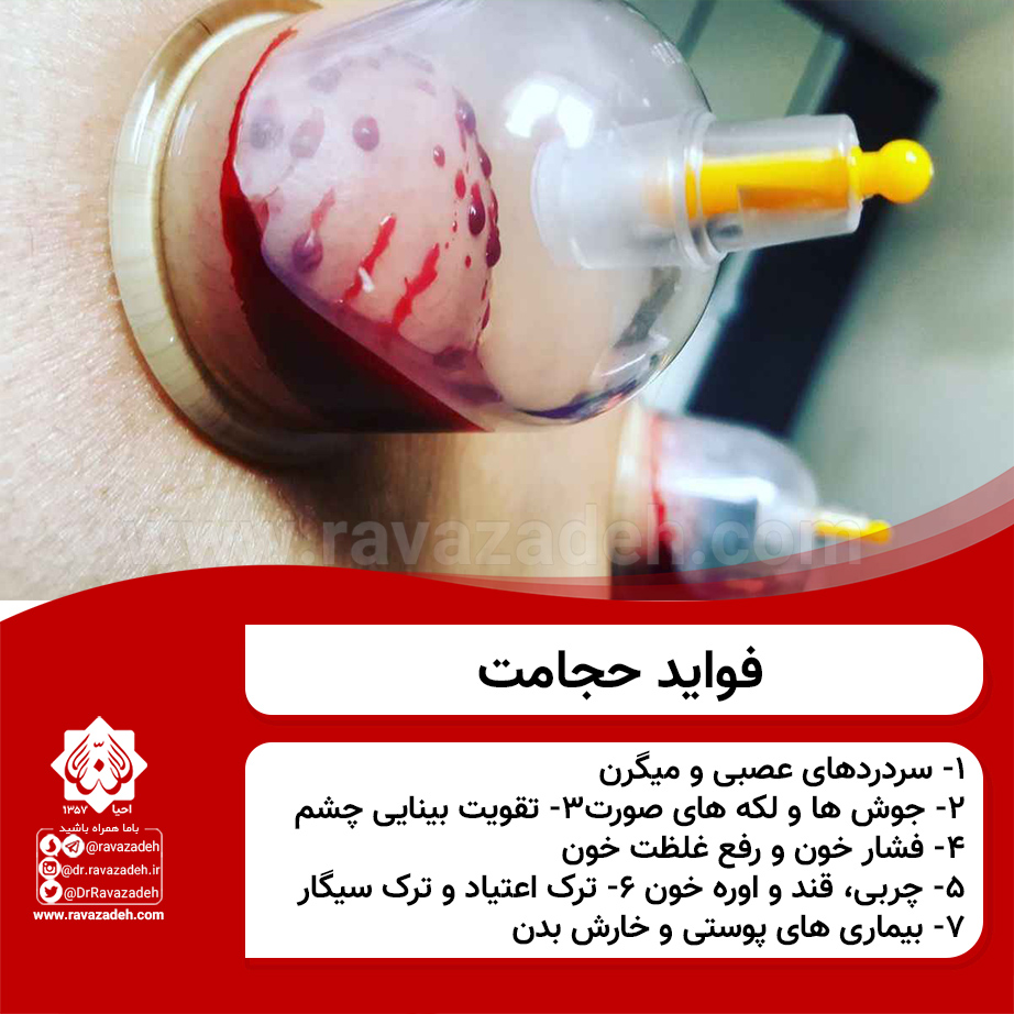 حجامت هدیه خداوند به پیامبران