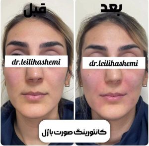 ورم بعد از تزریق ژل گونه چند روز طول میکشد؟